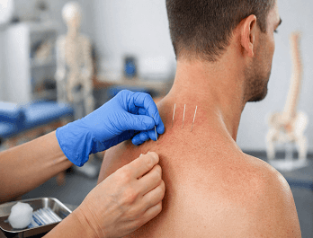 Kinergy Dry Needling